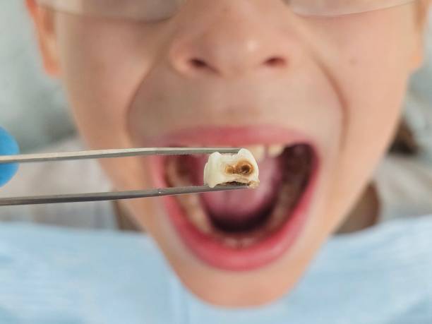 Best After-Hours Emergency Dentist in Bement, IL